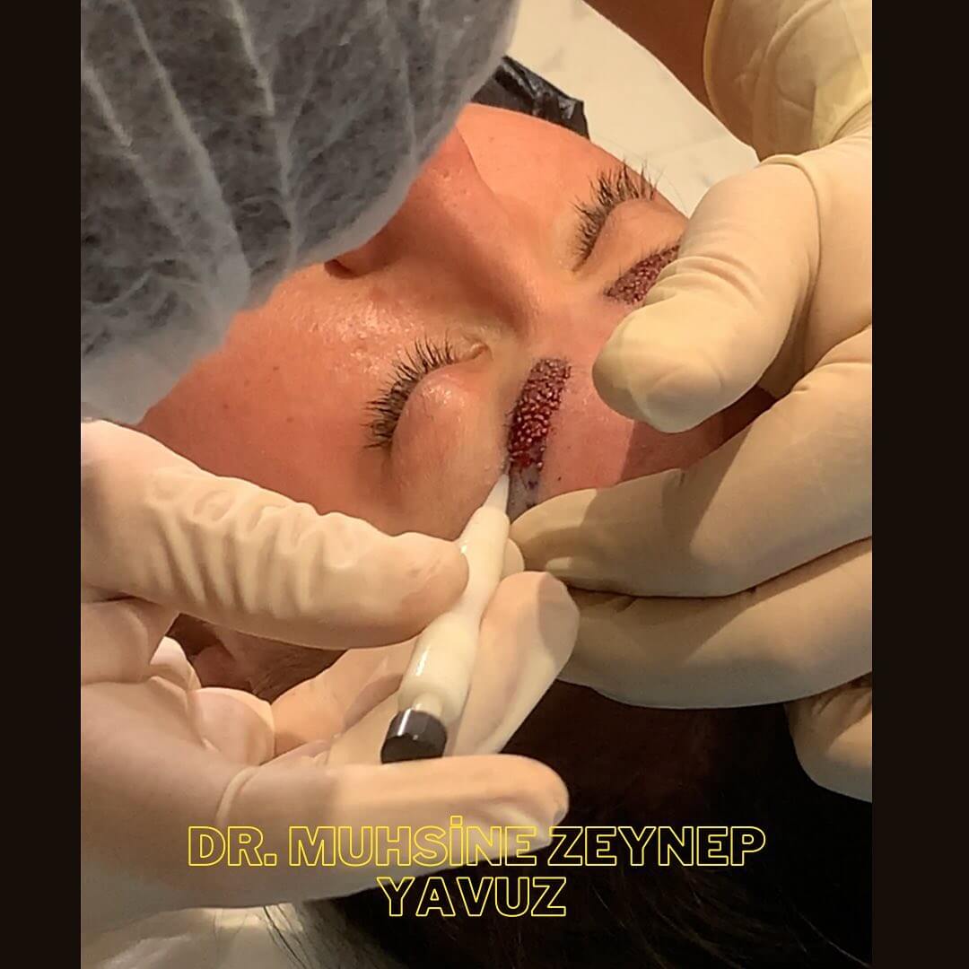 person undergoing eyebrow transplant procedure