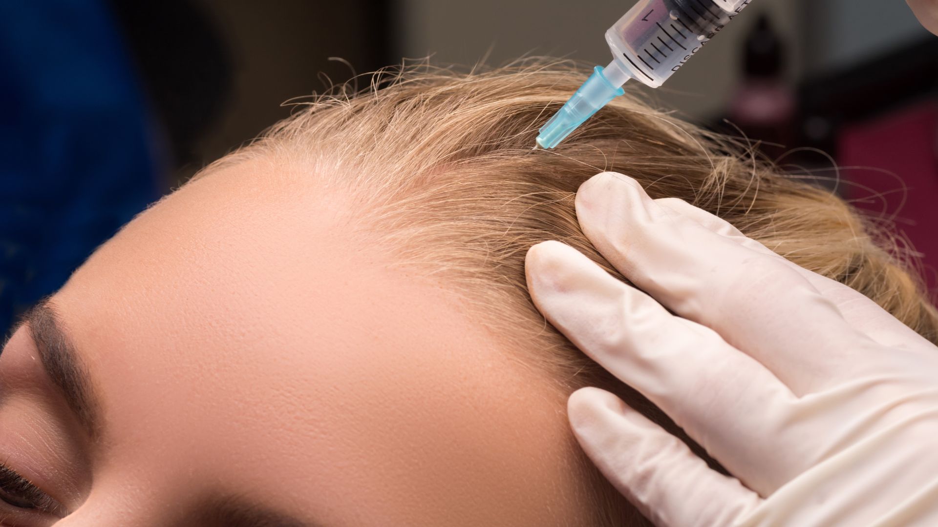 mesotherapy for mesotherapy-for-hair-loss-Istanbul-centers