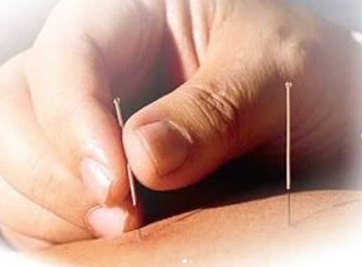Tubular-Baby (IVF) Treatment with Acupuncture in Istanbul